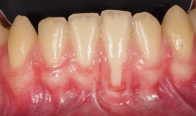 caso exito clinica dental murcia antes