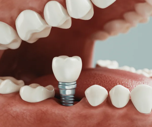 implante dental