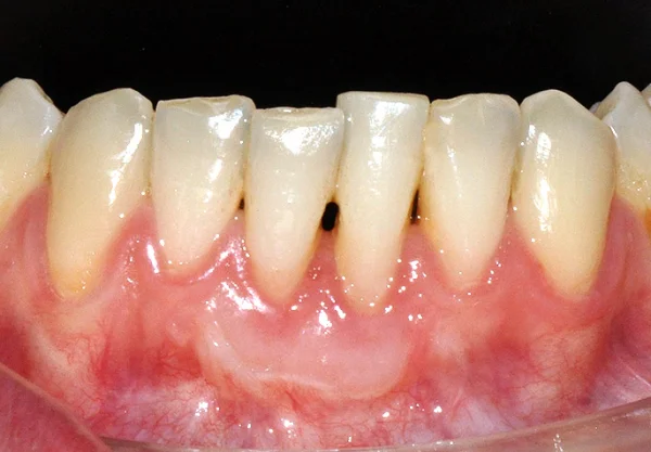 problema encía retraida