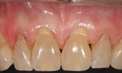 caso exito dental murcia antes